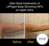 Sept 25 -  LIPOgen HIFU BODY SCULPTING, MELT FAT & TIGHTEN SKIN (Normally $998 per area)
