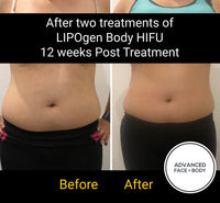 Sept 25 -  LIPOgen HIFU BODY SCULPTING, MELT FAT & TIGHTEN SKIN (Normally $998 per area)