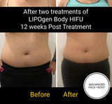 Sept 25 -  LIPOgen HIFU BODY SCULPTING, MELT FAT & TIGHTEN SKIN (Normally $998 per area)