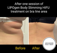 Sept 25 -  LIPOgen HIFU BODY SCULPTING, MELT FAT & TIGHTEN SKIN (Normally $998 per area)