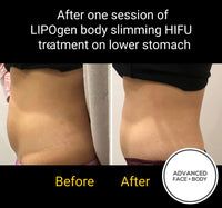 Sept 25 -  LIPOgen HIFU BODY SCULPTING, MELT FAT & TIGHTEN SKIN (Normally $998 per area)