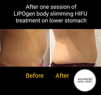 Sept 25 -  LIPOgen HIFU BODY SCULPTING, MELT FAT & TIGHTEN SKIN (Normally $998 per area)