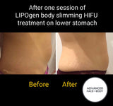 SEP 23 -  LIPOgen HIFU Body Sculpting ONLY $299 or 3 for $599 (Was $998.00 EACH)