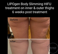 Sept 25 -  LIPOgen HIFU BODY SCULPTING, MELT FAT & TIGHTEN SKIN (Normally $998 per area)