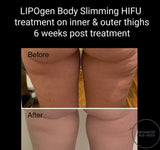 Sept 25 -  LIPOgen HIFU BODY SCULPTING, MELT FAT & TIGHTEN SKIN (Normally $998 per area)