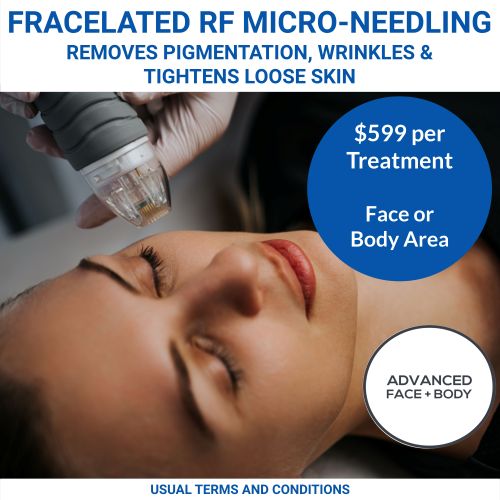 NOV 25 - Fracelated RF Micro-Needling Treatment Sale