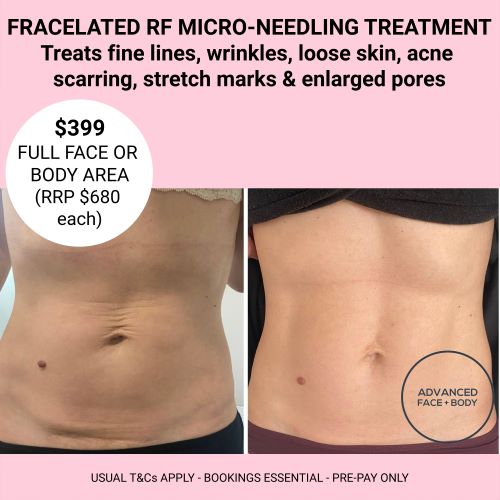 OCTOBER 24 - FRACELATED RF MICRO-NEEDLING TREATMENT (Treats wrinkles, loose skin, acne, scars, stretch marks & enlarged pores)