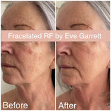 SEP 23 - FRACELATED RF MICRONEEDLING FACE OR BODY SKIN TREATMENT - ONLY $499 OR 3 FOR $599 (USUALLY $680 EACH)