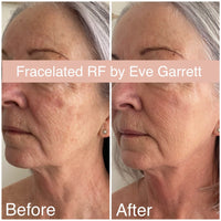 MAY SPECIAL - FRACELATED RF MICRO-NEEDLING - TOTAL SKIN REJUVINATION TREATMENT FOR FACE OR BODY
