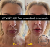 'ULTMAX' HIFU FACELIFT TREATMENT - THE ESSENTIAL NON SURGICAL FACELIFT