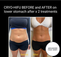 SEP 23 - CRYO-HIFU 7D ULTMAX BODY SLIMMING - ONLY $499 OR 3 FOR $599 (USUALLY $1999 EACH)