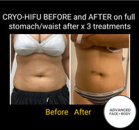 MAY SPECIAL - 8D HIFU BODY SLIM TREATMENT SALE - PERMANENTLY MELT FAT & TIGHTEN SKIN