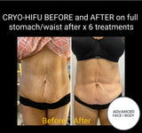 MAY SPECIAL - 8D HIFU BODY SLIM TREATMENT SALE - PERMANENTLY MELT FAT & TIGHTEN SKIN