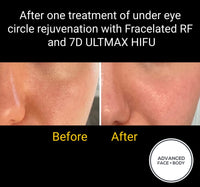 SEP 23 - THE ULTIMATE EYE LIFT - FRACELATED RF AND 7D ULTMAX HIFU - ONLY $299 OR 3 FOR $599 (USUALLY $1,179.00 EACH)
