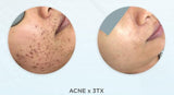 OFFER $99 DERMAPEN SKIN NEEDLING- LIMITED TIME INTRO OFFER FOR FIRST TIME CLIENTS - Skin Needling from $99 per session (Not $350)