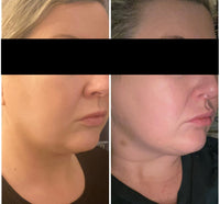 OFFER ULTMAX 7D HIFU Non Surgical Facelift - LIMITED INTRO OFFER FOR FIRST TIME CLIENTS - From $699 (Not $2,999)