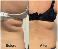 OFFER $399 LIPOGEN BODY HIFU - LIMITED TIME INTRO OFFER FOR FIRST TIME CLIENTS -LIPOgen HIFU Permanent Fat Melting and Skin Tightening Treatment Only $399 (Not $998) on one area or $499 for two areas (Not $1,996)