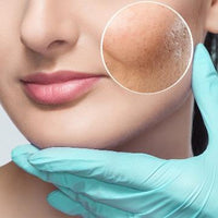 $79 INTRO OFFER Dermapen Skin Needling Treatment for first-time clients