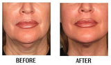 INTRO OFFER 5D HIFU - LIMITED OFFER FOR FIRST TIME CLIENTS - 5D HIFU Face Lift from only $375!